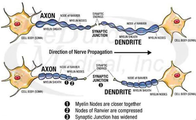 What-happens-to-nerves-when-deprived-of-oxygen--Actual-shrinkage-of-nerve-cells-resulting-in-widened-synaptic-junction Acupuncture treatment for Peripheral Neuropathy: What happens to nerves when deprived of oxygen? Actual shrinkage of nerve cells resulting in widened synaptic junction.